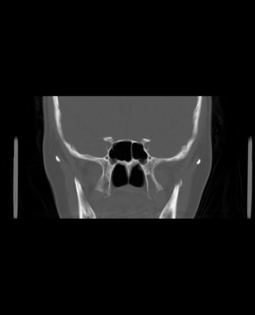 Automastoidectomy with labyrinthine fistula (Radiopaedia 84143-99411 Coronal non-contrast 59).jpg