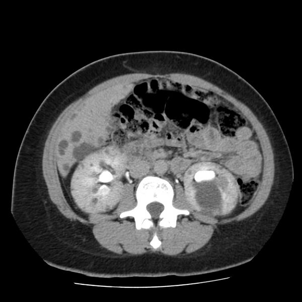 File:Autosomal dominant polycystic kidney disease (Radiopaedia 23061-23093 C+ delayed 34).jpg