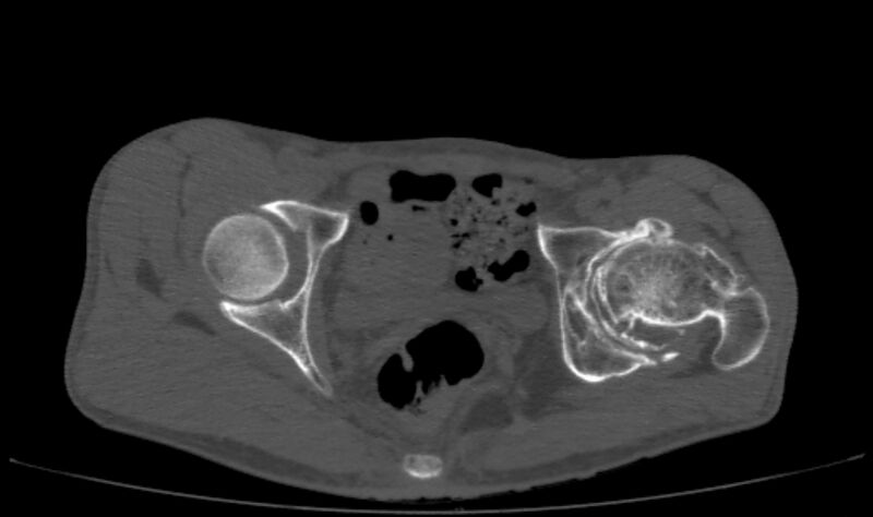 File:Avascular necrosis of the left hip (Radiopaedia 75068-86125 Axial bone window 47).jpg