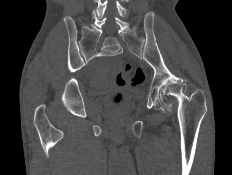 File:Avascular necrosis of the left hip (Radiopaedia 75068-86125 Coronal bone window 58).jpg