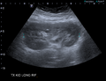 Avascular testicle (Radiopaedia 52327).png