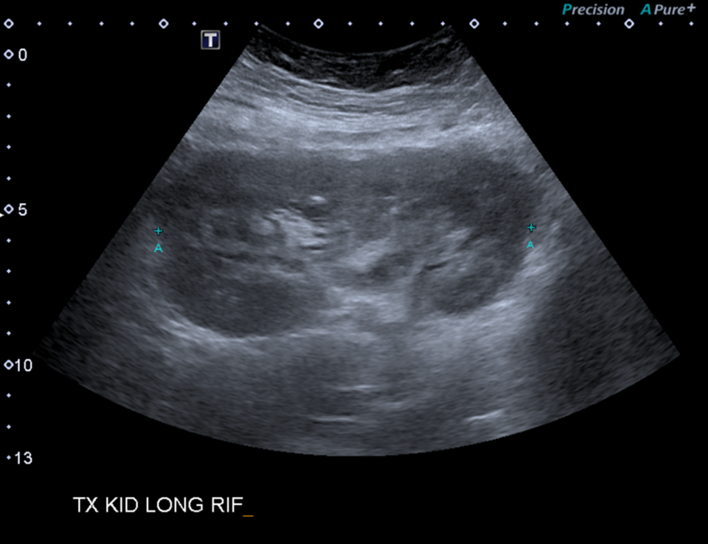 File:Avascular testicle (Radiopaedia 52327).png