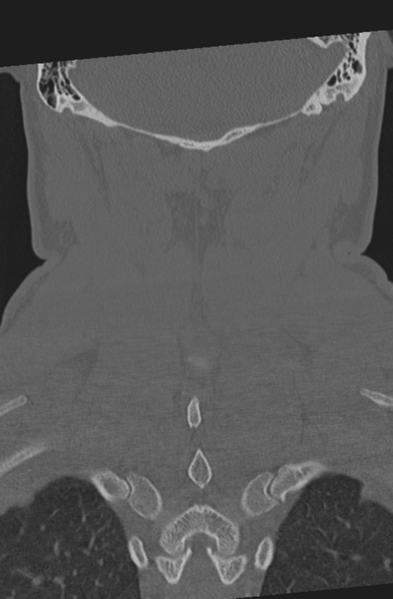 File:Axis peg fracture (type 3) and atlas lateral mass (type 4) fracture (Radiopaedia 37474-39324 Coronal bone window 49).png