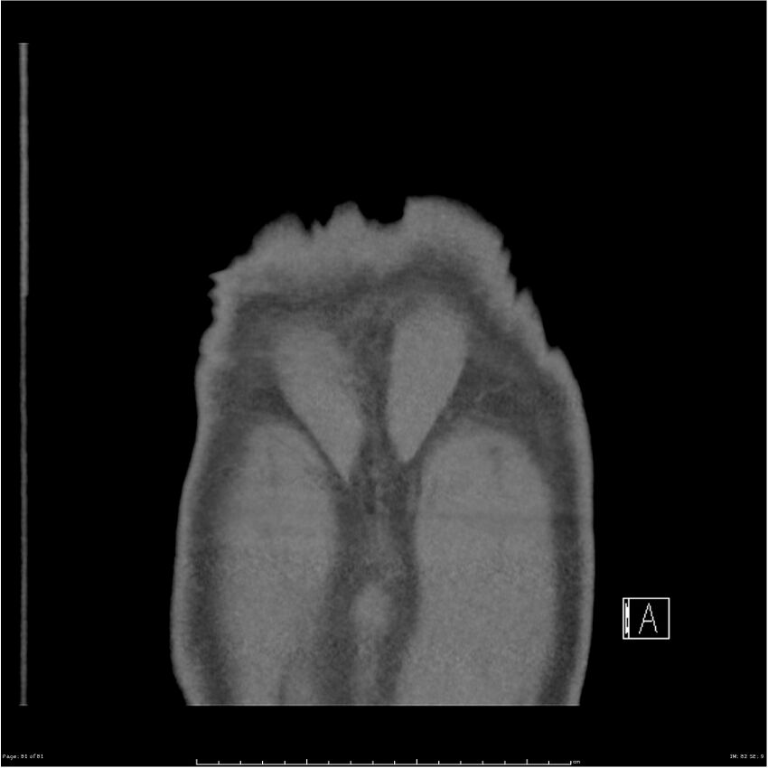 Azygos venous system anatomy (CT pulmonary angiography) (Radiopaedia 25928-26077 Coronal C+ CTPA 81).jpg