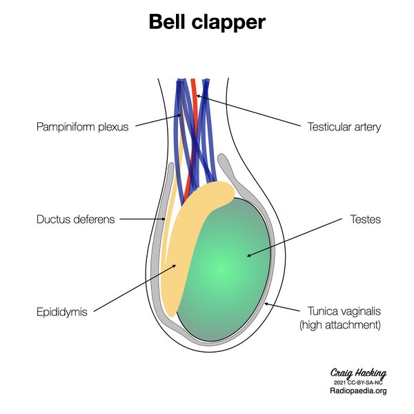 File:Bell clapper deformity (diagram) (Radiopaedia 86124-102079 D 1).jpeg
