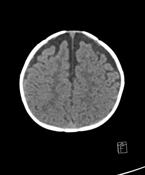 File:Benign enlargement of subarachnoid spaces in infancy (BESS) (Radiopaedia 87459-103795 Axial non-contrast 22).jpg