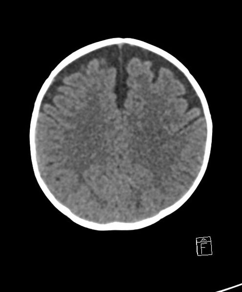 File:Benign enlargement of subarachnoid spaces in infancy (BESS) (Radiopaedia 87459-103795 Axial non-contrast 30).jpg
