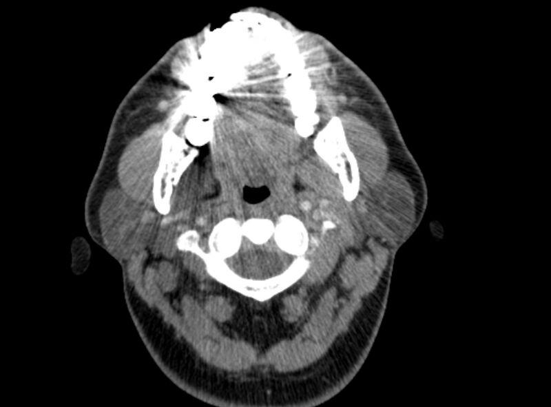 File:Benign mixed salivary tumor of the parotid gland (Radiopaedia 35261-36792 A 18).jpg