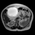 Benign seromucinous cystadenoma of the ovary (Radiopaedia 71065-81300 Axial T2 11).jpg