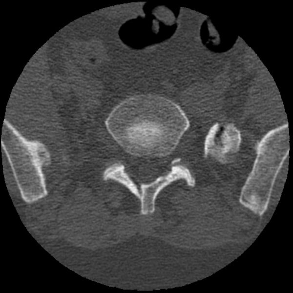 File:Bertolotti syndrome (Radiopaedia 24864-25128 Axial bone window 22).jpg
