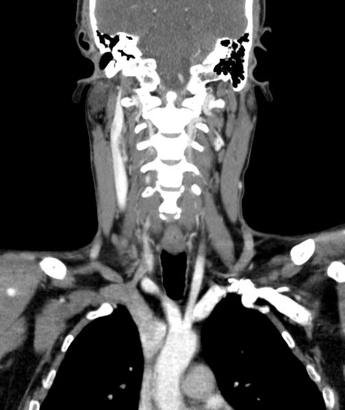 File:Bilateral carotid body tumors (Radiopaedia 52899-58827 B 35).jpg