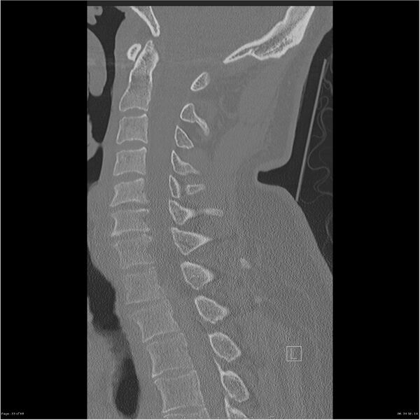 File:Bilateral cervical ribs (Radiopaedia 25868-26017 Sagittal bone window 33).jpg