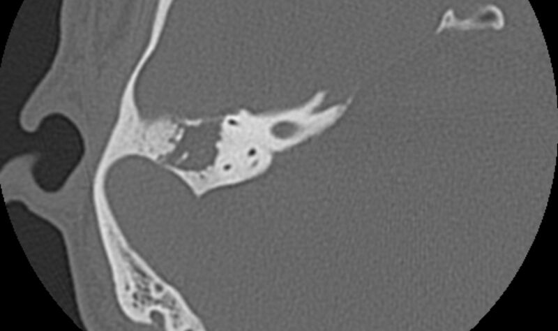 File:Bilateral cholesteatoma (Radiopaedia 54898-61172 Axial bone window 33).jpg