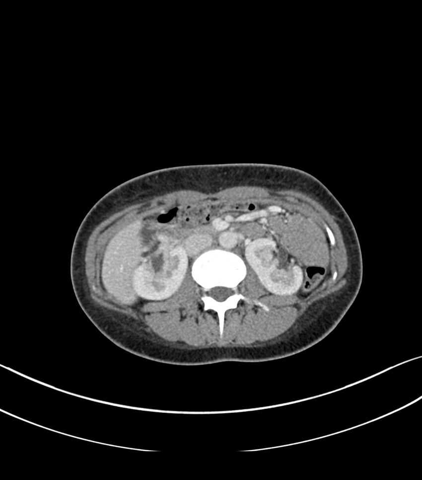 Bilateral kidney malrotation (Radiopaedia 72227-82749 A 22).jpg