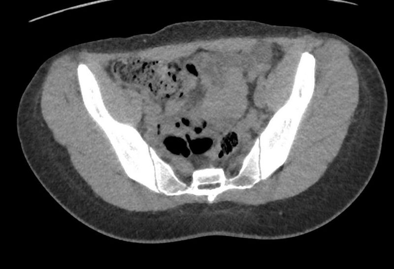 File:Bilateral mature cystic ovarian teratoma (Radiopaedia 88821-105592 Axial non-contrast 2).jpg