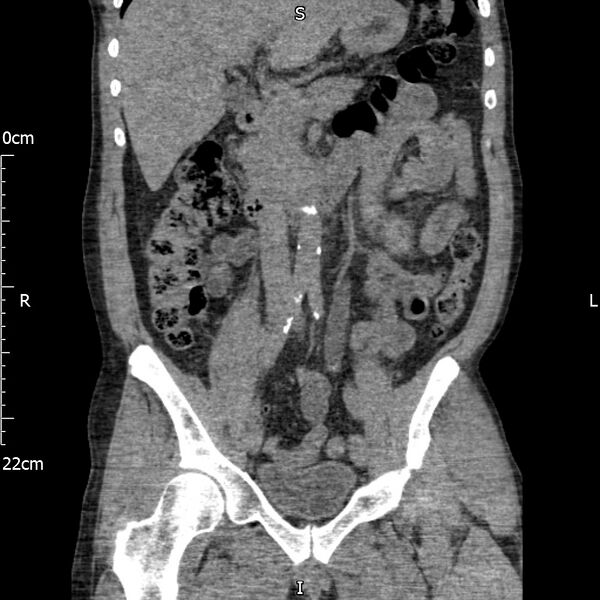 File:Bilateral medullary nephrocalcinosis with ureteric calculi (Radiopaedia 71269-81569 Coronal non-contrast 30).jpg
