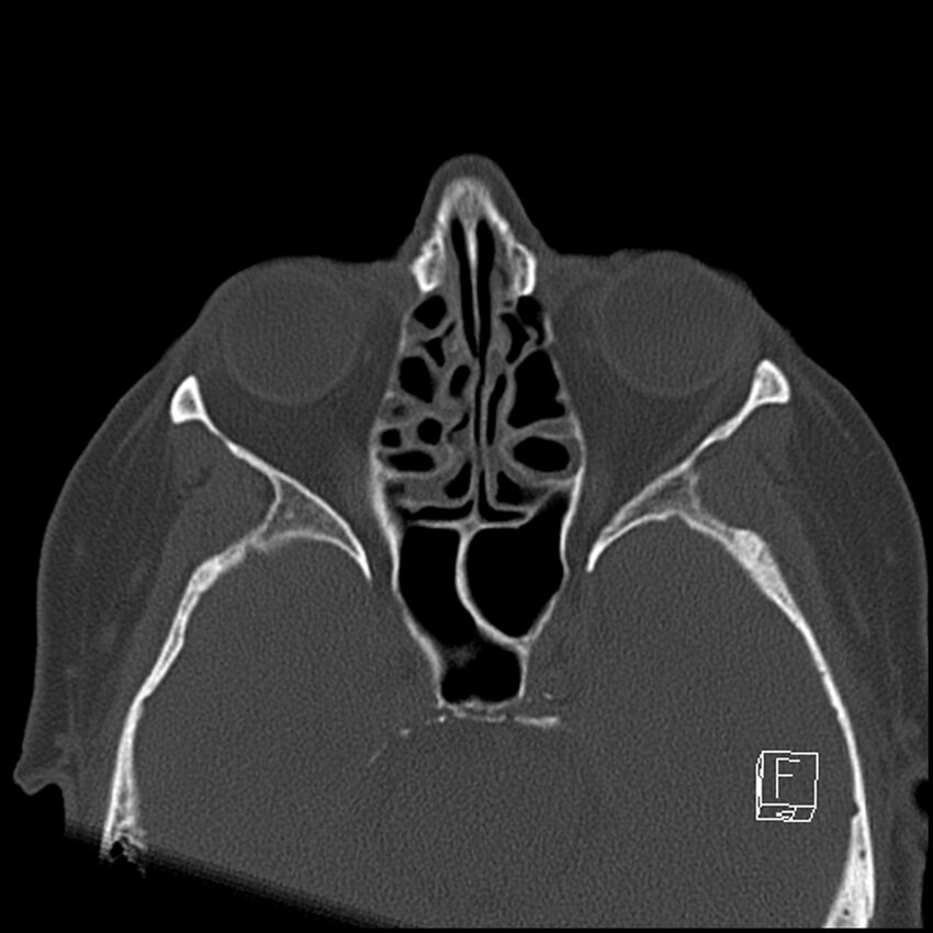 Bilateral palatine tonsilloliths on OPG and CT (Radiopaedia 75167-86247 Axial bone window 10).jpg