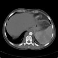 Biliary necrosis - liver transplant (Radiopaedia 21876-21846 A 10).jpg