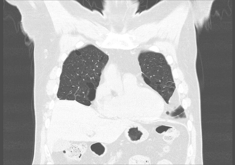 File:Birt-Hogg-Dubé syndrome (Radiopaedia 52578-58491 Coronal lung window 9).jpg