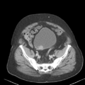 Bladder papillary urothelial carcinoma (Radiopaedia 48119-52951 Axial 46).png