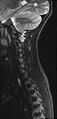Brachial plexus birth palsy (Radiopaedia 68118-77604 Sagittal T2 10).jpg