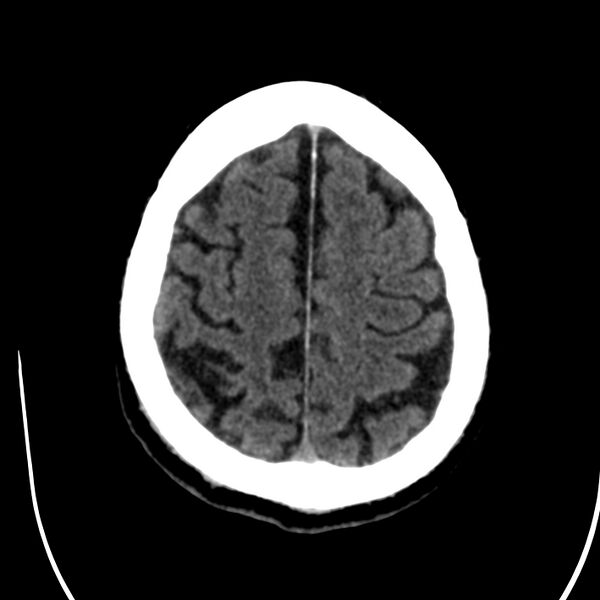 File:Brain Pantopaque remnants (Radiopaedia 78403-91048 Axial non-contrast 73).jpg