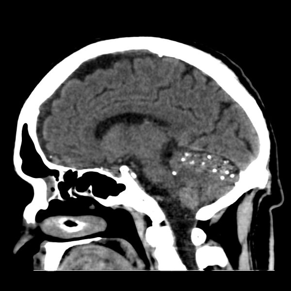File:Brain Pantopaque remnants (Radiopaedia 78403-91048 C 33).jpg