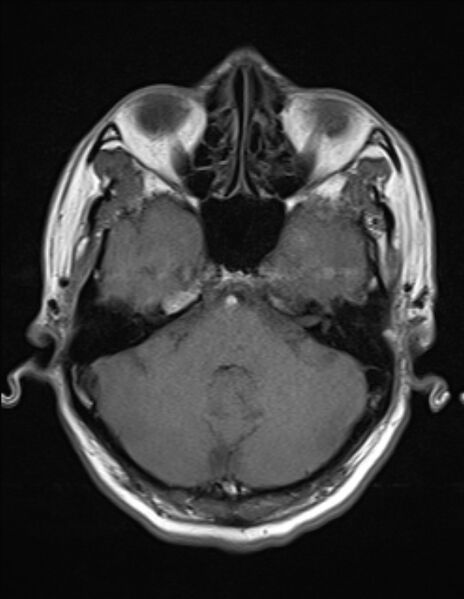 File:Brain abscess with ventriculitis (Radiopaedia 85703-101495 Axial T1 6).jpg
