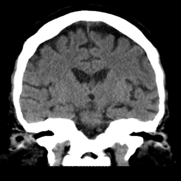 File:Brain cortical laminar necrosis (Radiopaedia 25822-25971 C 29).jpg