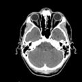 Brain death (Radiopaedia 78597-91360 Axial non-contrast 18).jpg
