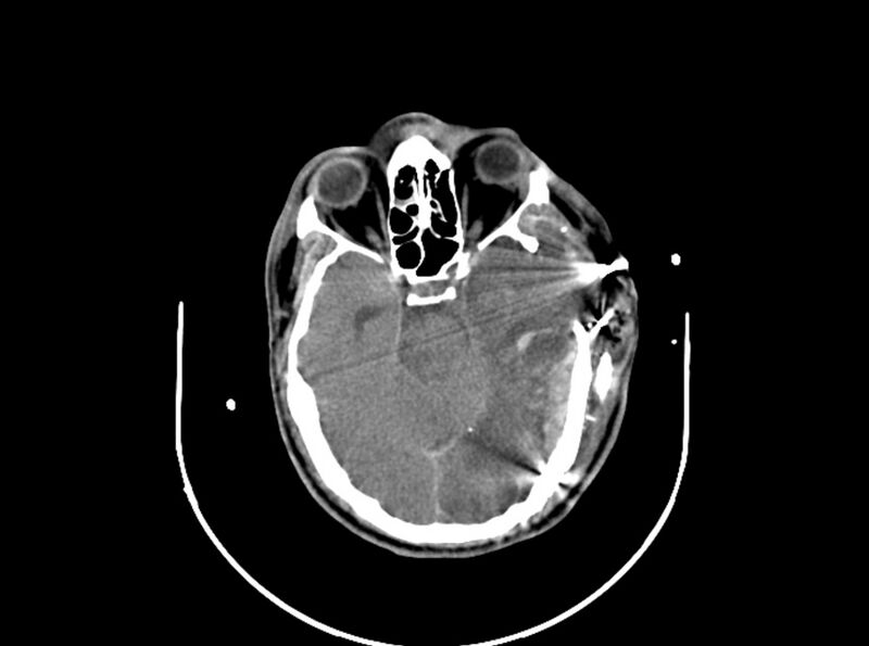 File:Brain injury by firearm projectile (Radiopaedia 82068-96087 B 82).jpg