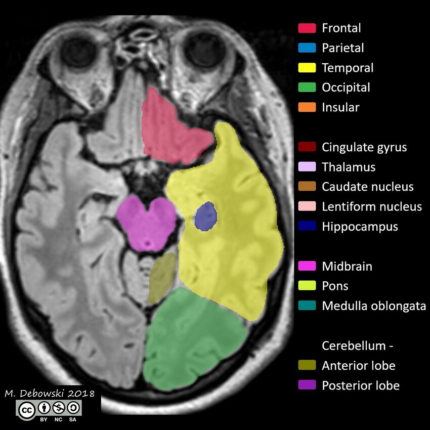 Brain lobes - annotated MRI (Radiopaedia 61691-69700 Axial 48).JPG