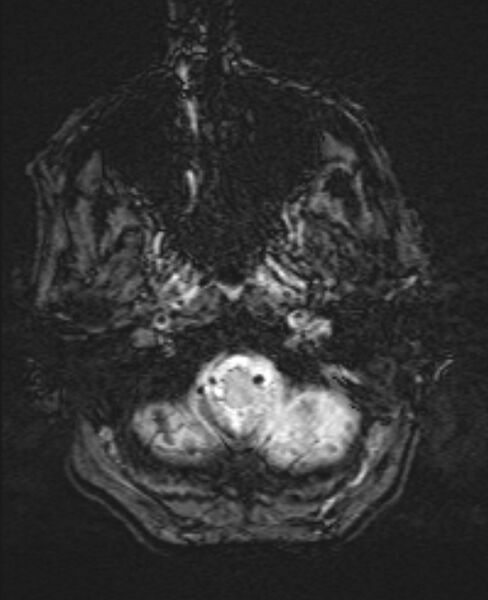 File:Brain metastases - lung cancer primary (Radiopaedia 75060-86115 Axial SWI 7).jpg