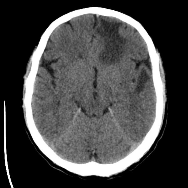 File:Brain metastases from lung cancer (Radiopaedia 24480-24781 Axial non-contrast 18).jpg