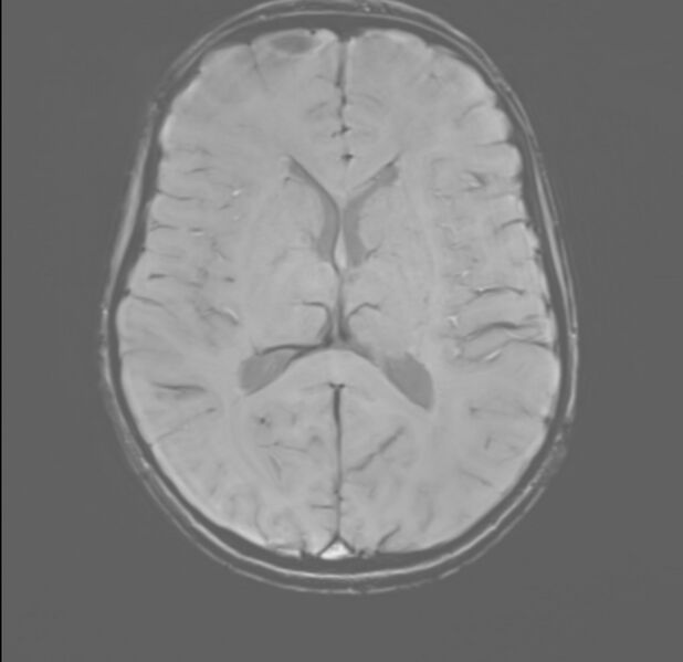 File:Brainstem glioma (Radiopaedia 70548-80674 Axial SWI 35).jpg