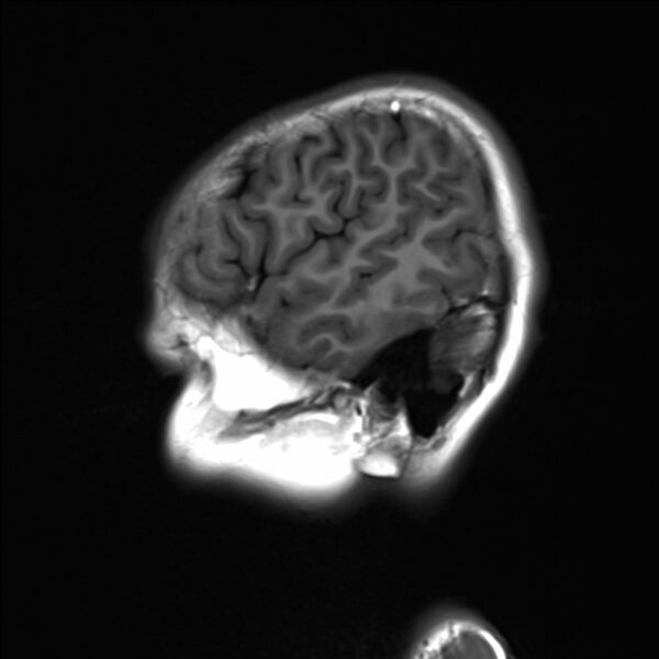 File:Brainstem glioma (Radiopaedia 70548-80674 Sagittal T1 22).jpg