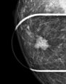 Breast cancer and multiple circumscribed masses (Radiopaedia 62456-70699 RMLO spot 1).jpeg