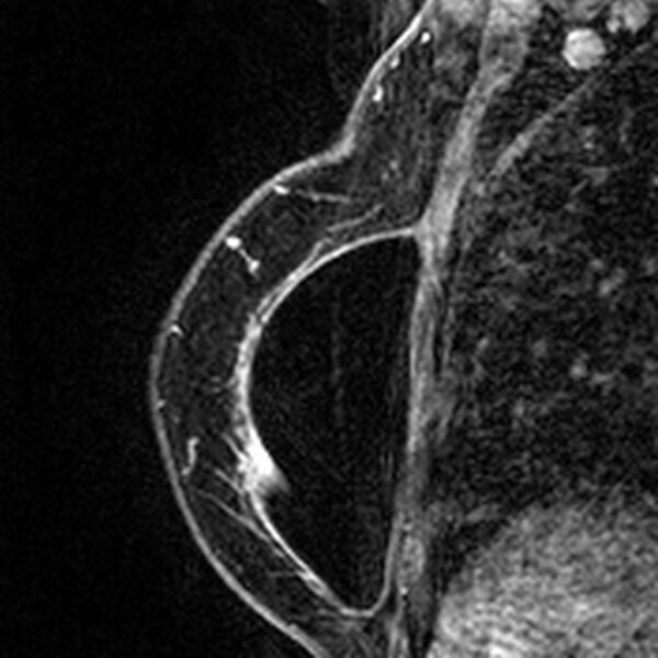 File:Breast implants - MRI (Radiopaedia 26864-27035 Sagittal T2 90).jpg