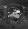 Broad ligament leiomyoma (Radiopaedia 81634-95516 Axial T1 C+ fat sat 18).jpg