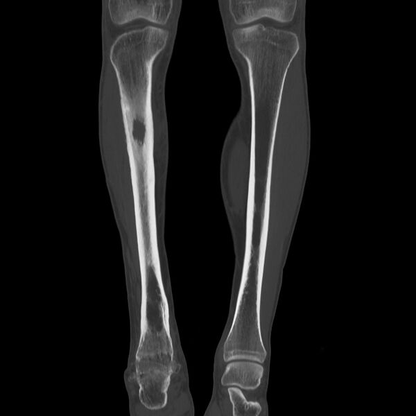 File:Brodie abscess - tibia (Radiopaedia 66028-75204 Coronal bone window 17).jpg