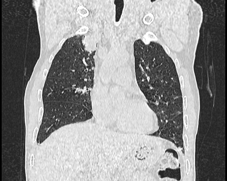 File:Bronchogenic carcinoma with superior vena cava syndrome (Radiopaedia 36497-38054 Coronal lung window 10).jpg