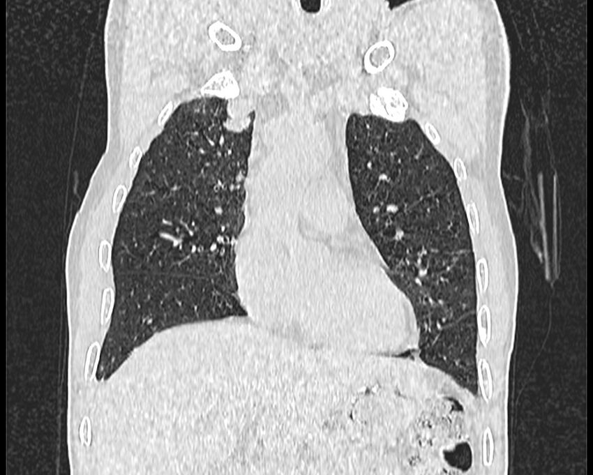 Bronchogenic carcinoma with superior vena cava syndrome (Radiopaedia 36497-38054 Coronal lung window 3).jpg