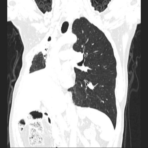 File:Bronchopleural fistula - postoperative complication (Radiopaedia 21020-20947 Coronal lung window 14).jpg