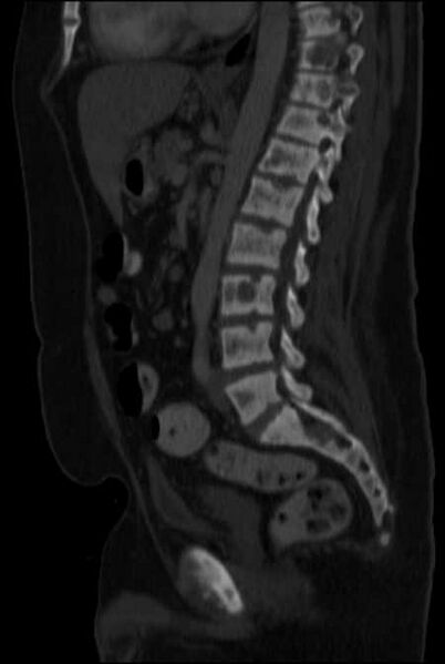File:Brown tumors compressing the spinal cord (Radiopaedia 68442-77988 H 31).jpg