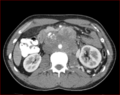 Burned-out testicular choriocarcinoma (Radiopaedia 32822-34040 B 9).PNG