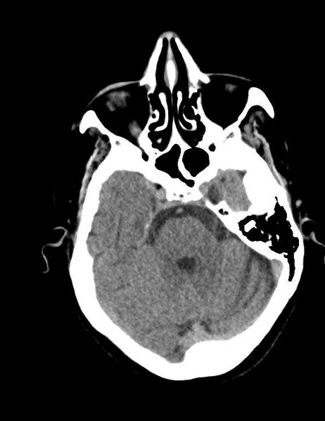 File:Burnt-out meningioma (Radiopaedia 51557-57337 Axial non-contrast 11).jpg