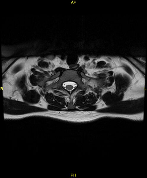 File:C5 nerve sheath tumor (Radiopaedia 85777-101596 Axial T2 74).jpg