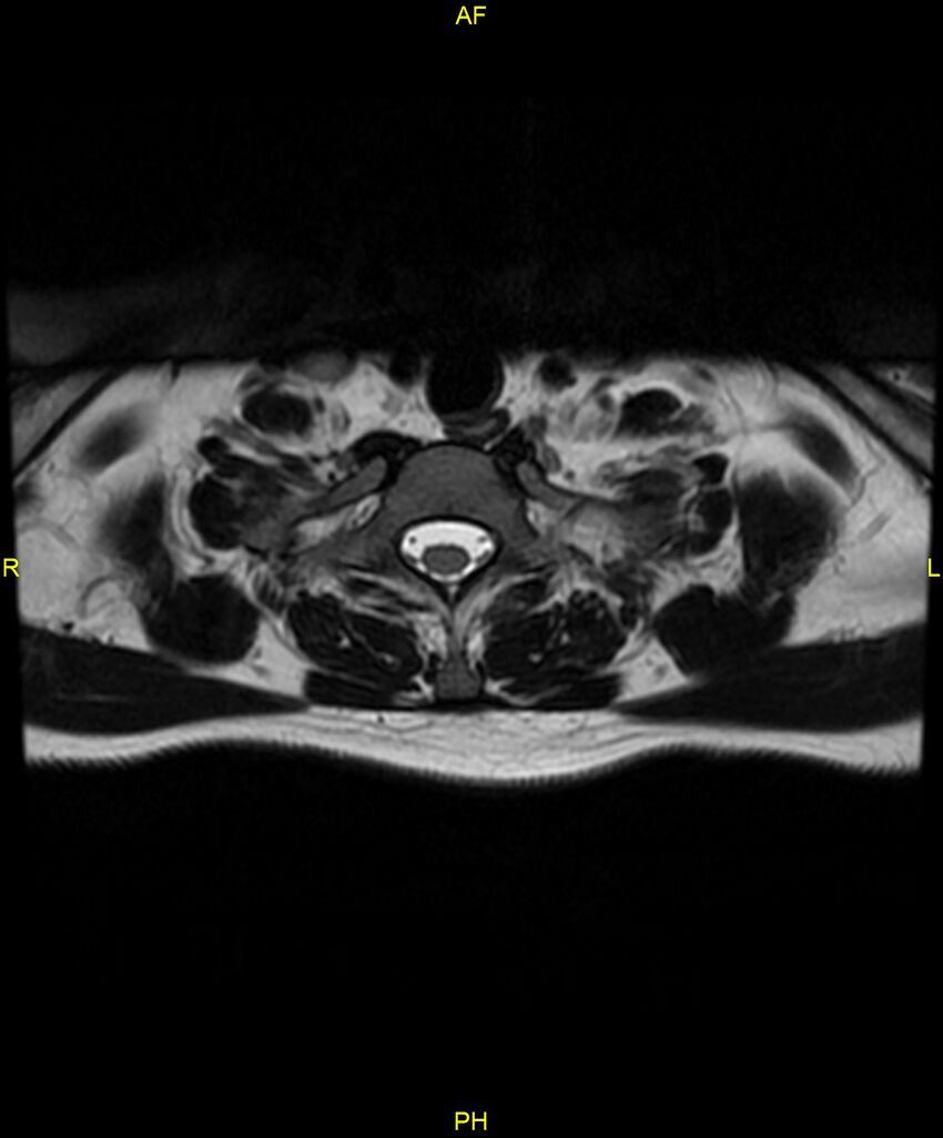 C5 nerve sheath tumor (Radiopaedia 85777-101596 Axial T2 74).jpg