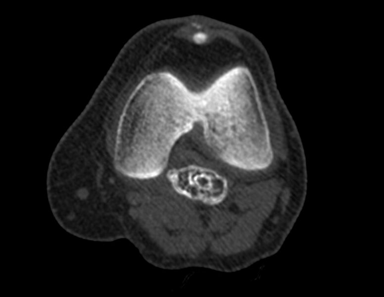File:Calcified hematoma - popliteal fossa (Radiopaedia 63938-72763 Axial bone window 12).jpg