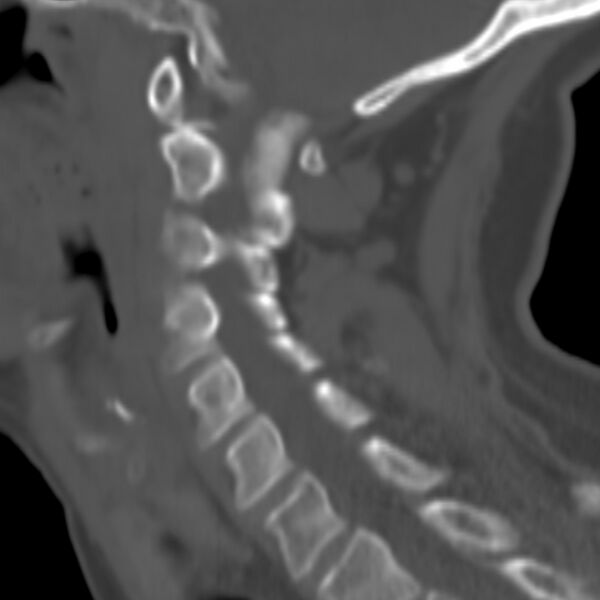 File:Calcified meningioma - cervical canal (Radiopaedia 70136-80171 Sagittal bone window 9).jpg